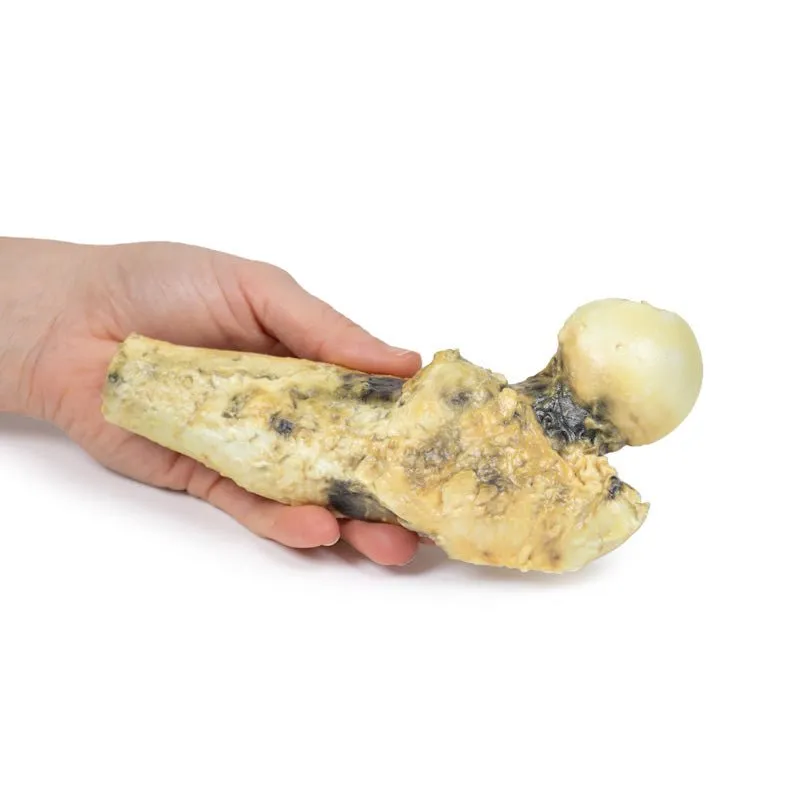 3D Printed Chondrosarcoma