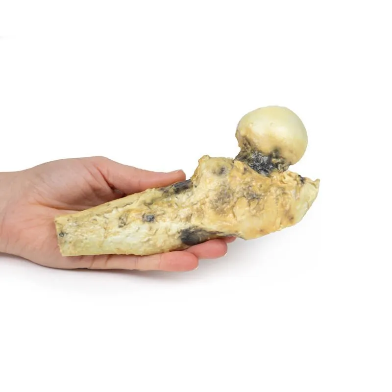 3D Printed Chondrosarcoma